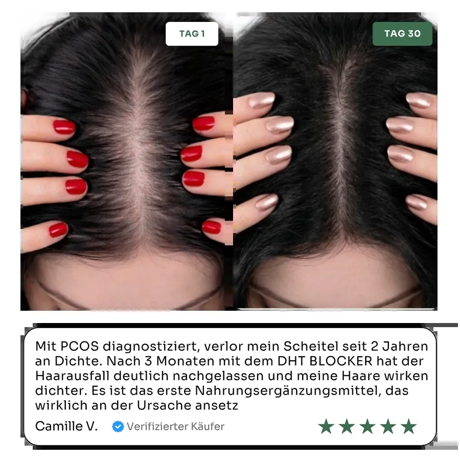 Nuclever DHT Blocker prima e dopo donna: densità dei capelli sulla riga al giorno 1 e al giorno 30