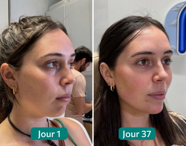 Risultato Nuclever: viso più definito dopo 37 giorni di cura